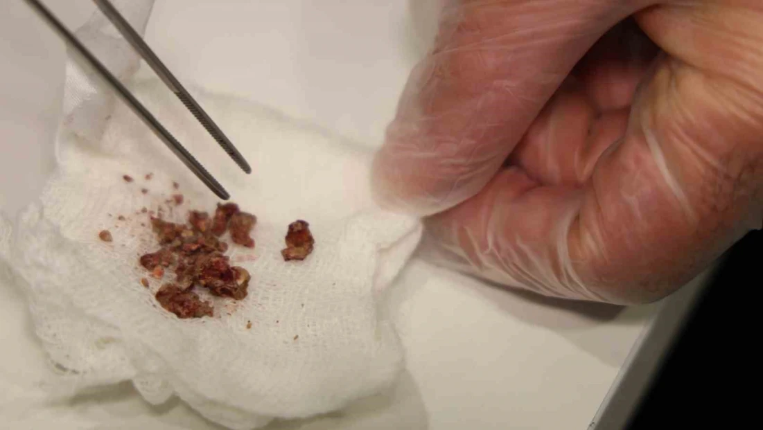 Elazığ'da estetik ameliyatta şaşırtan olay, burundan taş çıktı