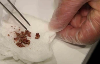 Elazığ'da estetik ameliyatta şaşırtan olay, burundan taş çıktı