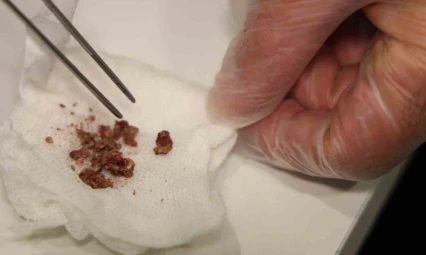 Elazığ'da estetik ameliyatta şaşırtan olay, burundan taş çıktı