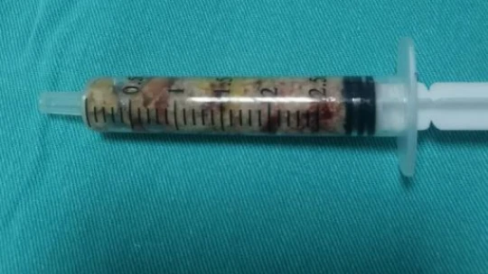 13 aylık bebeğin böbreğinden çıkan taş şaşırttı