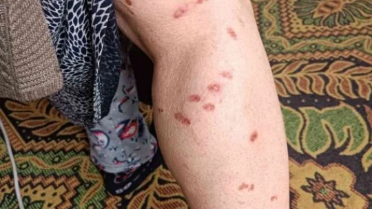 Bir güzellik merkezi skandalı daha: Lazer işleminde kadının vücudunu yaktılar