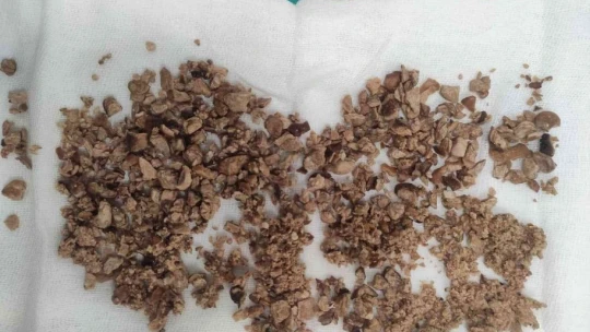 Böbreğinde 13 santimlik taş tespit edilen hasta, kapalı ameliyatla sağlığına kavuştu