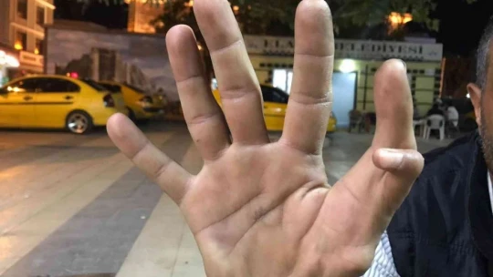 Elazığ'da 11 parmaklı adam görenleri hayrete düşürüyor