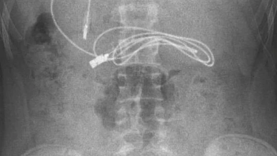 Kusma ve karın ağrısı şikayetiyle doktora giden çocuğun karnından telefon şarj kablosu çıktı