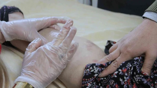 Lazer kadının vücudunu yakmıştı, başka bir güzellik uzmanı tedavisini üstlendi