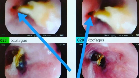 Yemek borusunu delen cismin turp olduğunu zannetti, gerçek sonradan ortaya çıktı
