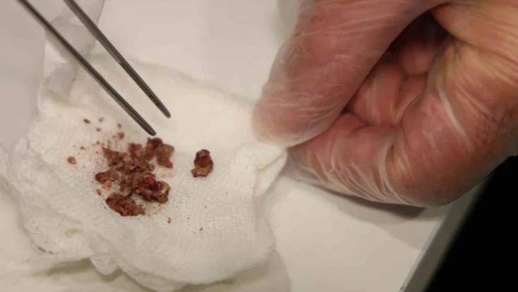 Elazığ'da estetik ameliyatta şaşırtan olay, burundan taş çıktı