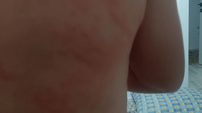 Elazığ'da böcek ısırığı hastanelik etti